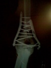 My right elbow